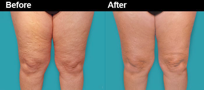 Cellulite treatment with Cellulaze at Aset Hospital liverpool